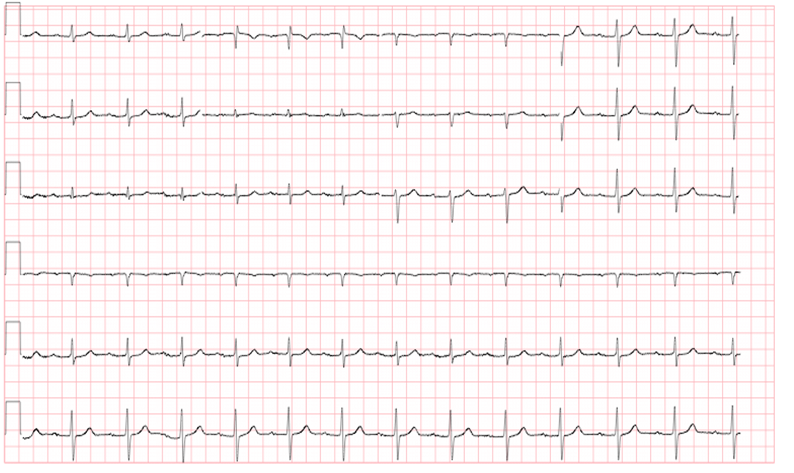 M3 Fig 1 Conduction Abnormalities -ecg-13