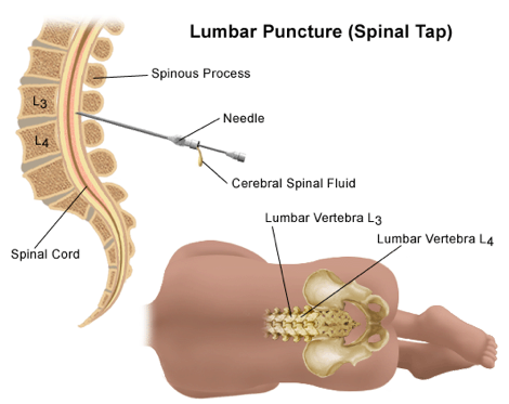 M3 Fig 1 Lumbar Puncture_positioning