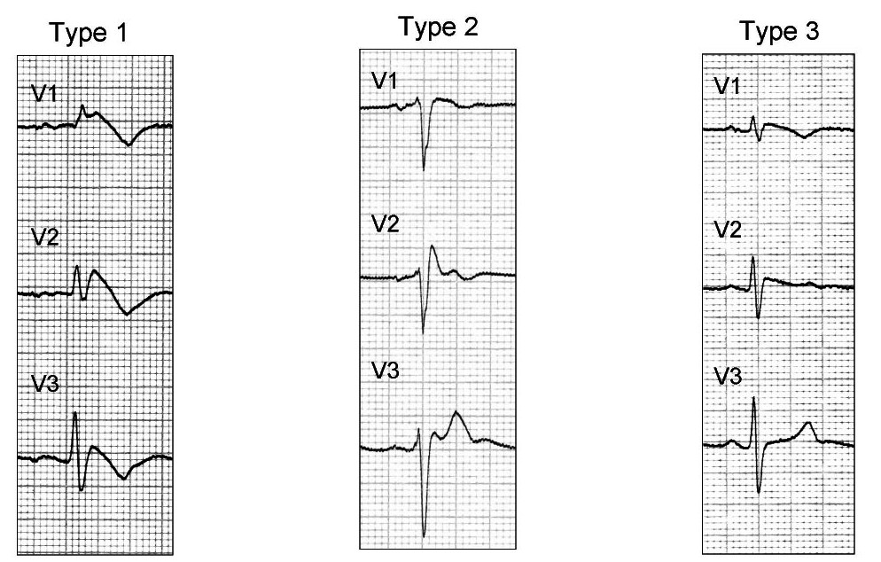 M3 Fig 10 Conduction Abnormalities -ecg-10