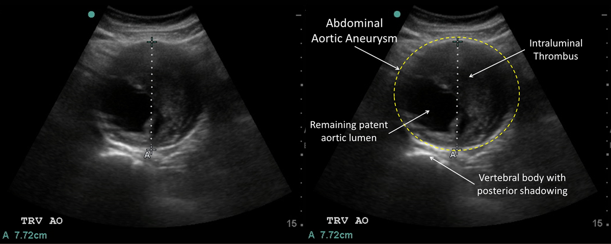 M3 Fig 11 Bedside Ultrasound-normal-fast-aaa-labled