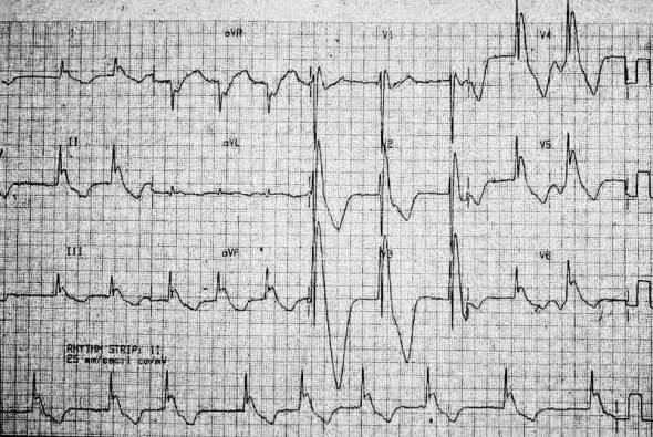 M3 Fig 11 Conduction Abnormalities -ecg-11