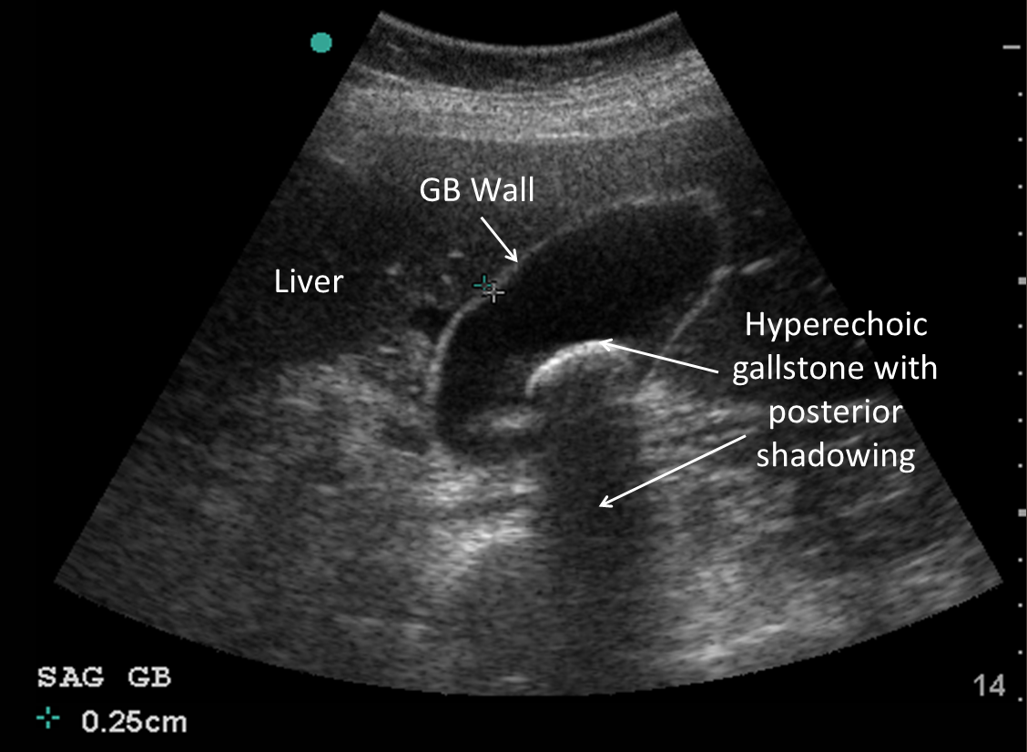 M3 Fig 12 Bedside Ultrasound-normal-fast-cholelithiasis-labled