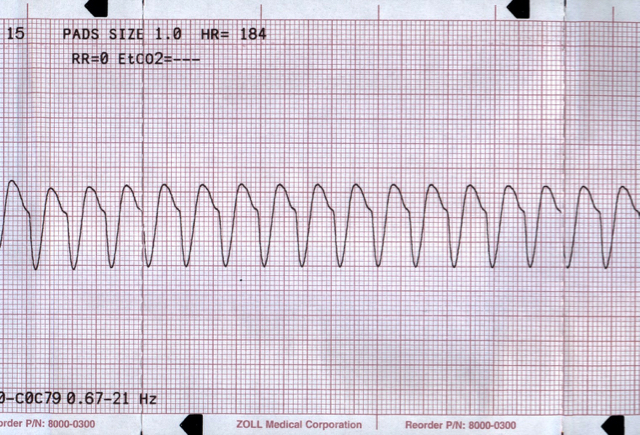 M3 Fig 2 Cardiac Arrest Ventricular Tachycardia