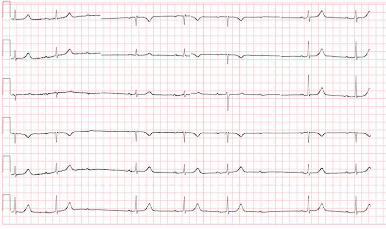 M3 Fig 2 Conduction Abnormalities -ecg-22