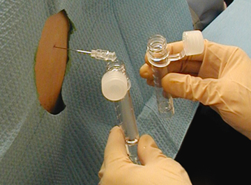 M3 Fig 2 Lumbar Puncture -getting_fluid