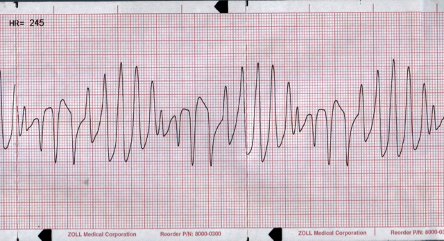 M3 Fig 3 Cardiac Arrest Torsades