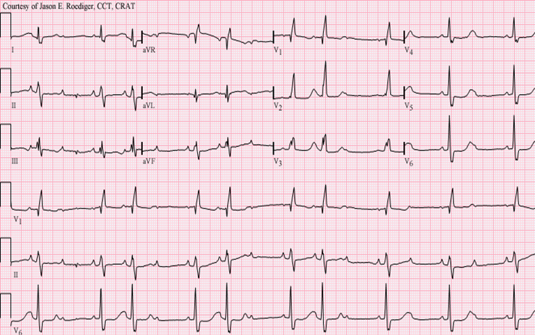 M3 Fig 3 Conduction Abnormalities -ecg-31