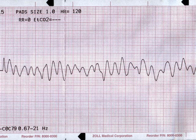 M3 Fig 4 Cardiac Arrest Ventricular Fibrillation