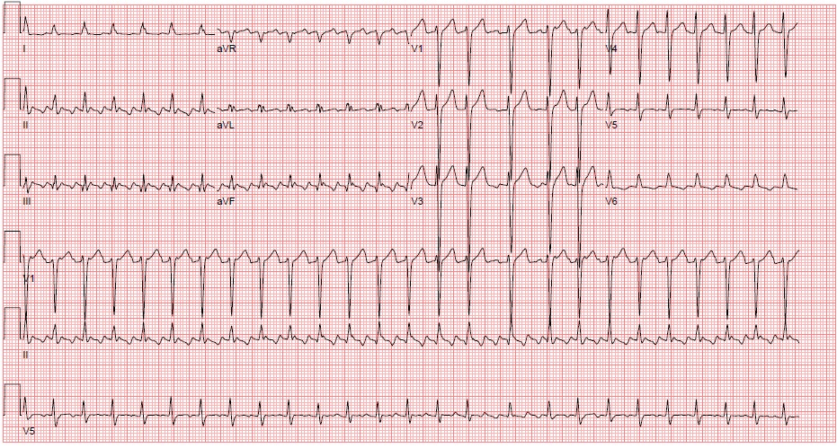 M3 Fig 4 Circulation -atrial-flutter-with-2-1-conduction