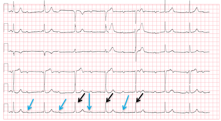 M3 Fig 4 Conduction Abnormalities -ecg-42