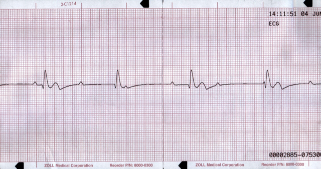 M3 Fig 5 Cardiac Arrest Pulseless Electrical Activity