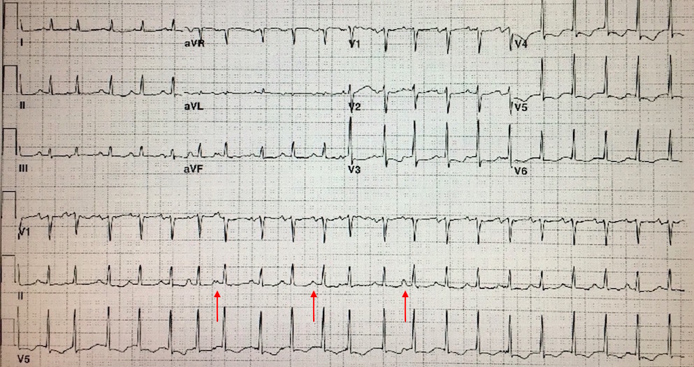 M3 Fig 5 Circulation-multifocal-atrial-tachycardia