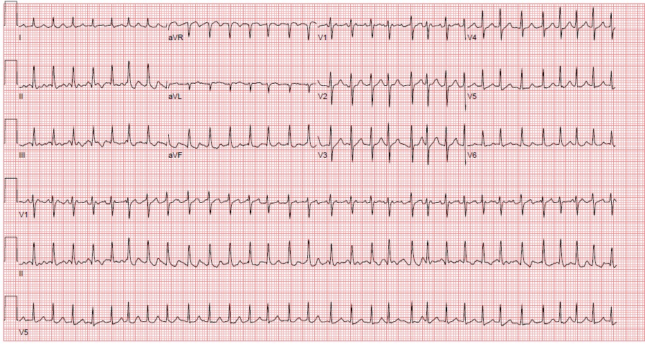 M3 Fig 6 Circulation-atrial-fibrillation