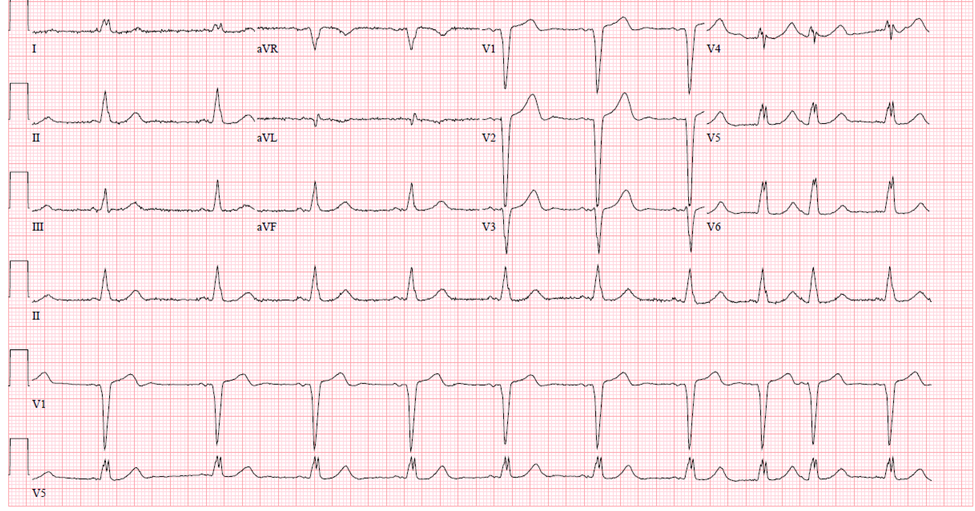 M3 Fig 6 Conduction Abnormalities -ecg-61