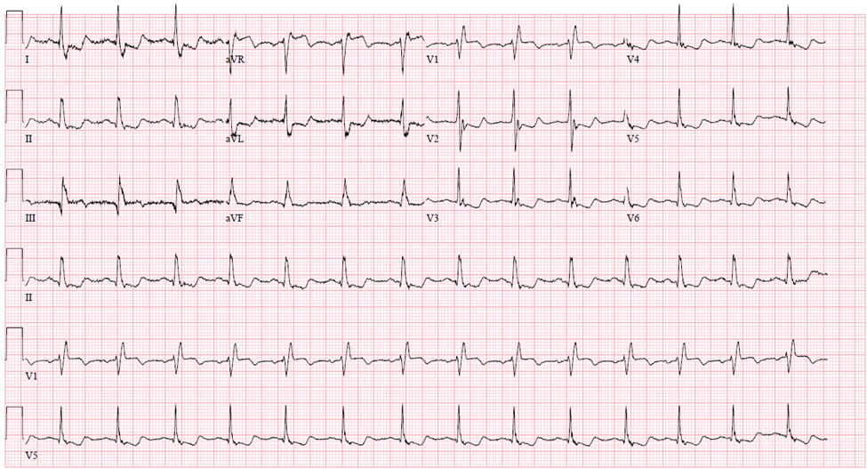 M3 Fig 7 Conduction Abnormalities-ecg-71