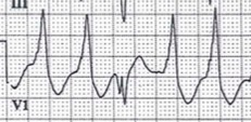 M3 Fig 7a Circulation-fusion-beat