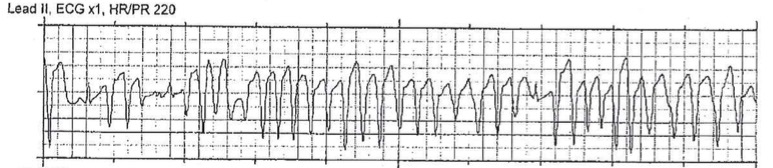 M3 Fig 8 Circulation-torsades-de-pointes