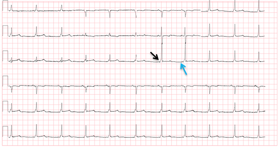 M3 Fig 8 Conduction Abnormalities-ecg-82