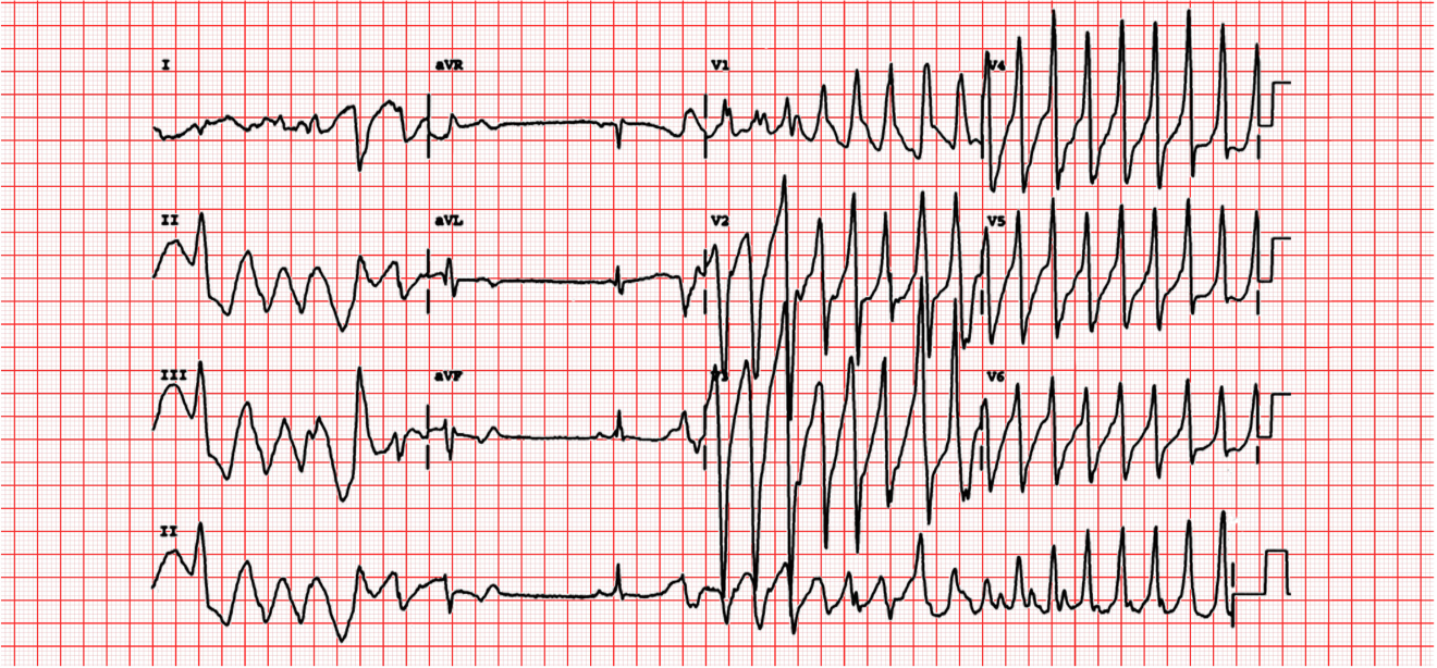 M3 Fig 9 Conduction Abnormalities-ecg-9