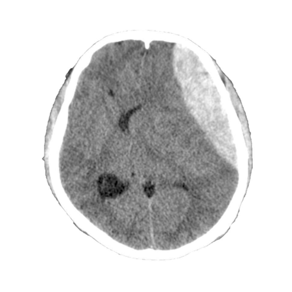 M4 Fig 1 Closed Head Injury