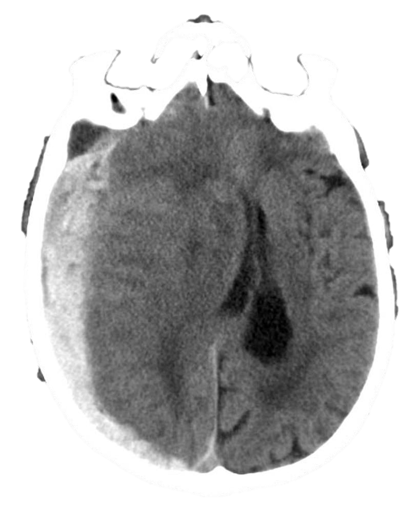 M4 Fig 2 Closed Head Injury Subdural Hematoma