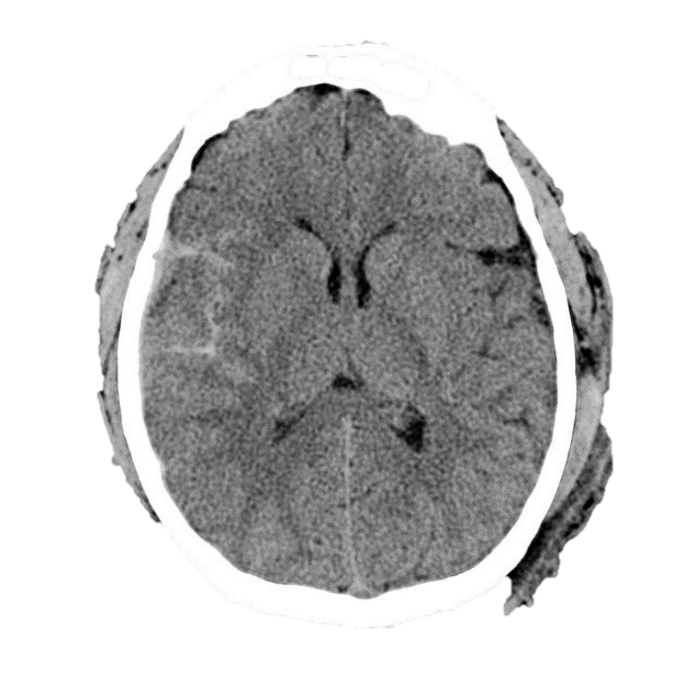 M4 Fig 3 Closed Head Injury Traumatic Subarachnoid Hemorrhage