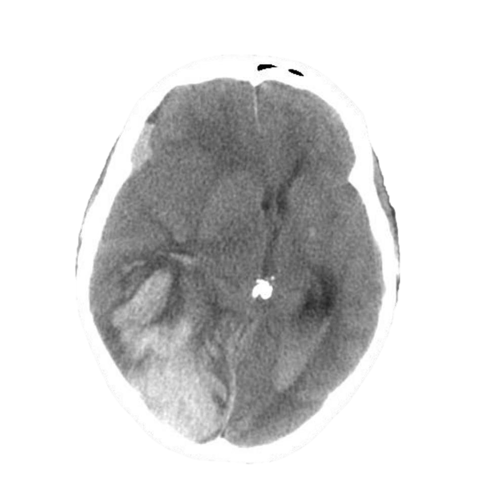 M4 Fig 4 Closed Head Injury 